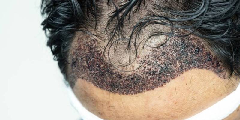 Understand Hair Transplant After 10 Years Before You Regret Healthy Cyte