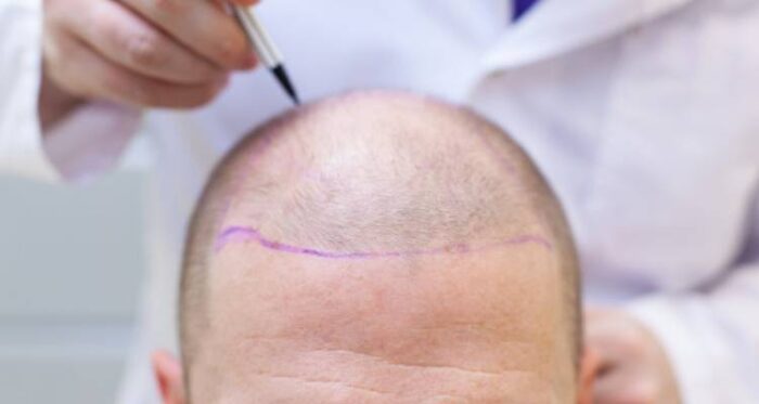 Hair Transplant After 10 Years