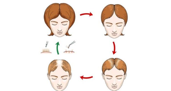 Stages of hair loss