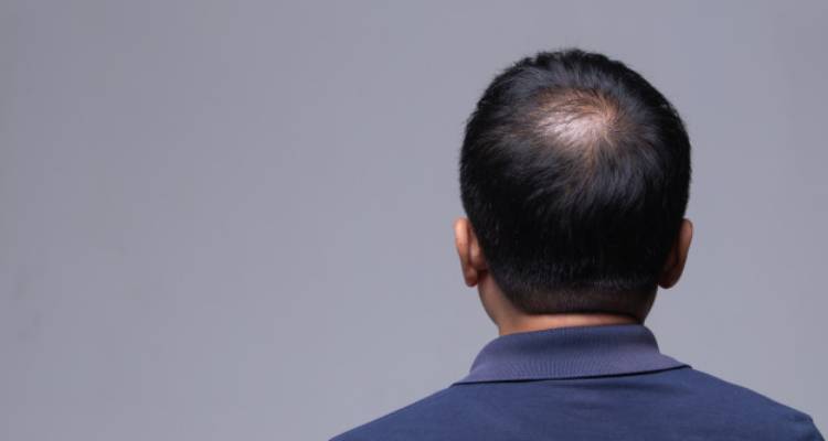 Signs and Symptoms of alopecia areata