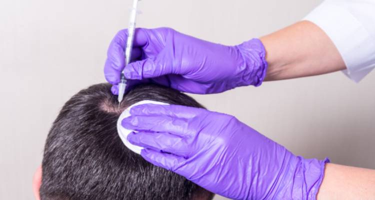 Treatment for Alopecia areata