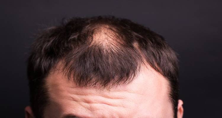 How is Alopecia areata Diagnosed?