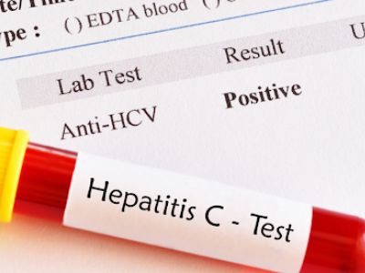 Laboratory diagnosis of Hepatitis C