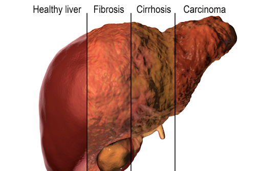 Stucture of liver in hepatitis D