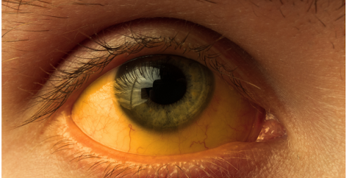 Pale Yellow eyes symptoms